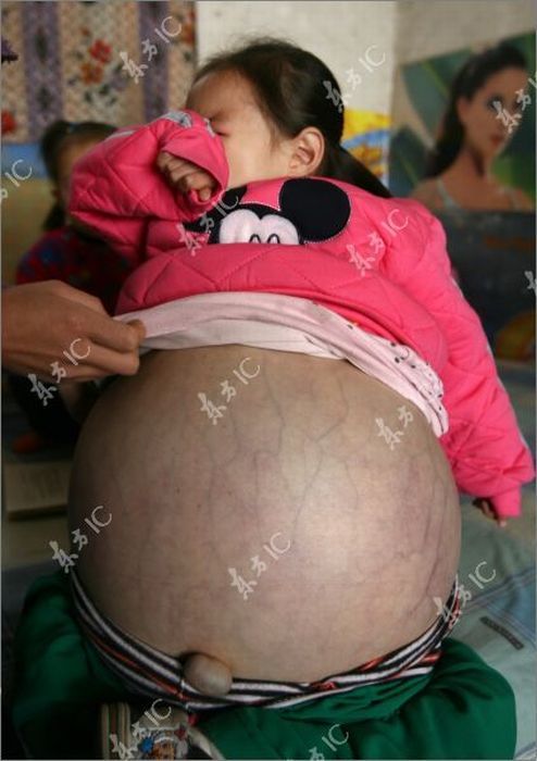 4-летняя девочка с огромным животом (19 фото)